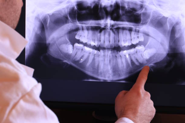 Best Emergency Dental Extractions in Rock Hall, MD